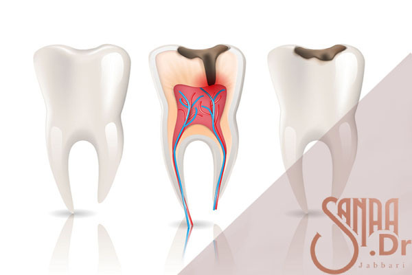پر کردن و عصب کشی دندان