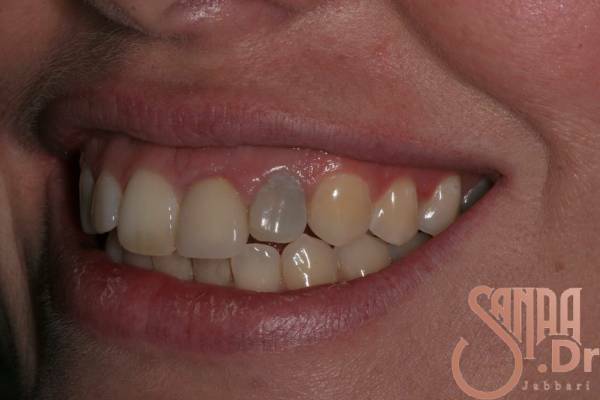 دلایل تغیر رنگ دندان بعد عصب کشی
