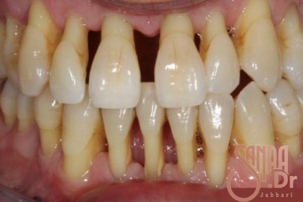 عصب کشی دندان یا ایمپلنت دندان