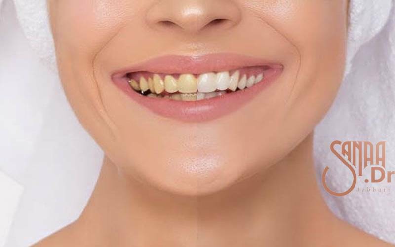 دلایل تغییر رنگ دندان بعد عصب کشی