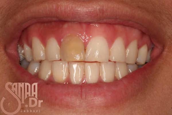 دلایل تغیر رنگ دندان بعد عصب کشی