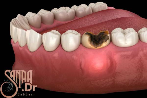 علائم عفونت دندان