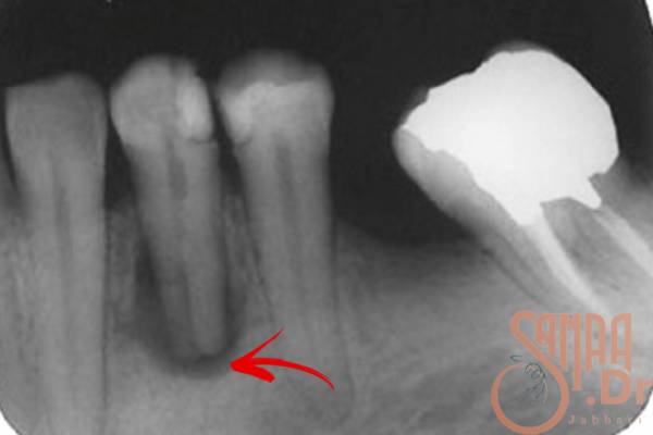 اگر دندان را عصب کشی نکنیم چه اتفاقی می افتد؟