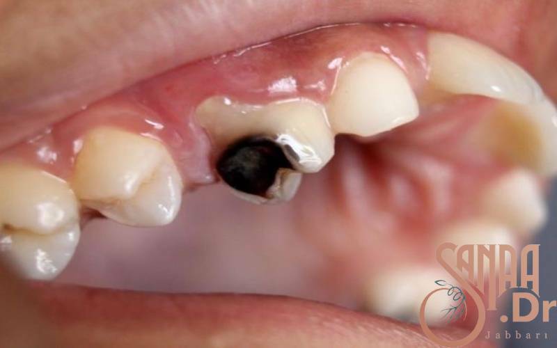 اگر دندان را عصب کشی نکنیم چه اتفاقی می افتد؟
