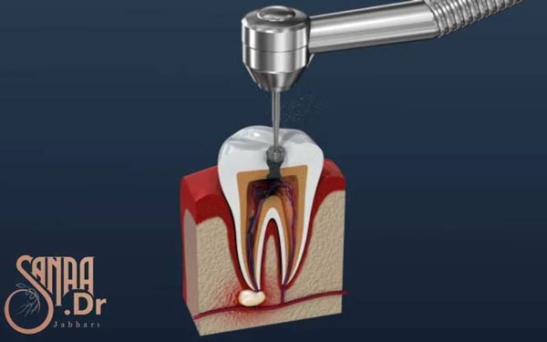 درمان عفونت ریشه دندان که به صورت سه بعدی عکس دارد.