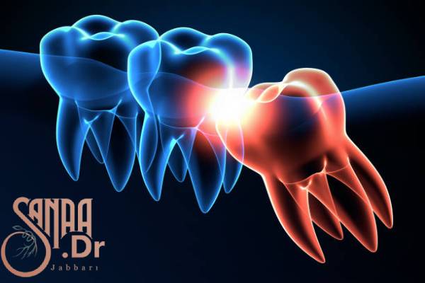 عصب کشی دندان عقل