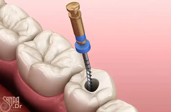 دندانی که دارد درمان عصب کشی روی آن انجام می شود.