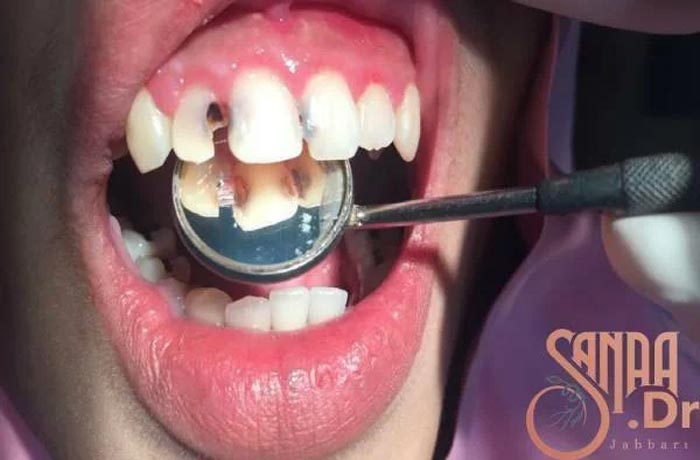 معاینه دندان فرد به همراه آیینه دندان پزشکی