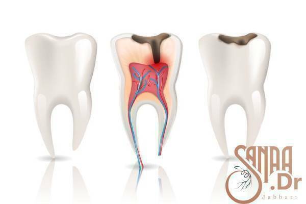 عصب کشی دندان آسیا