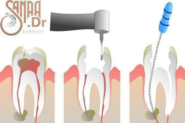 عصب کشی دندان آسیا