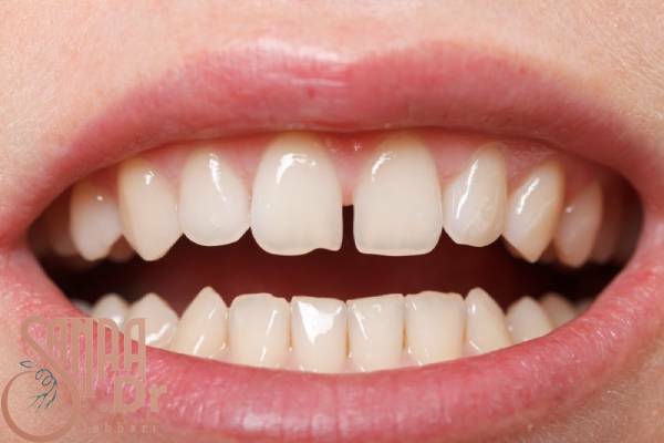 فاصله بین دندان‌های جلو و تاثیر آن بر صورت
