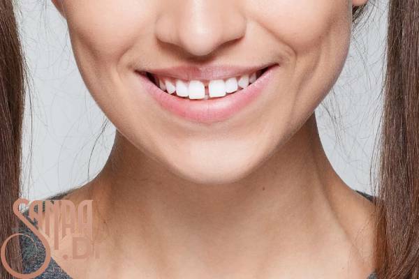 فاصله بین دندان‌های جلو و تاثیر آن بر صورت