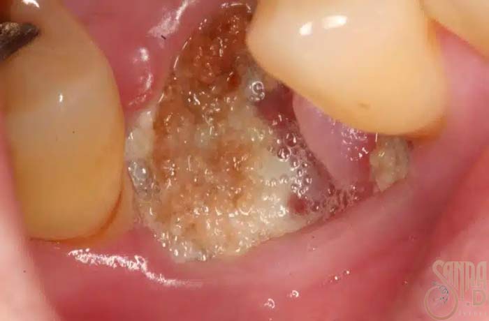 دندان فرد که کشیده شده است.