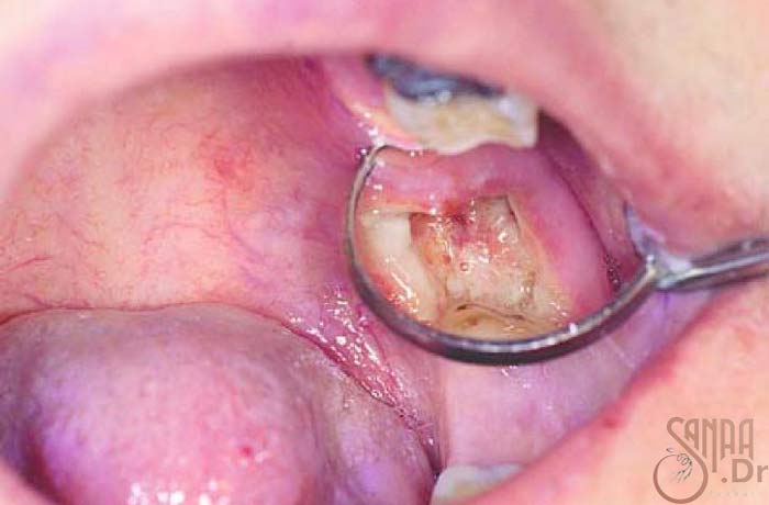 دندان فردی که عفونت کرده و با آیینه می بیند