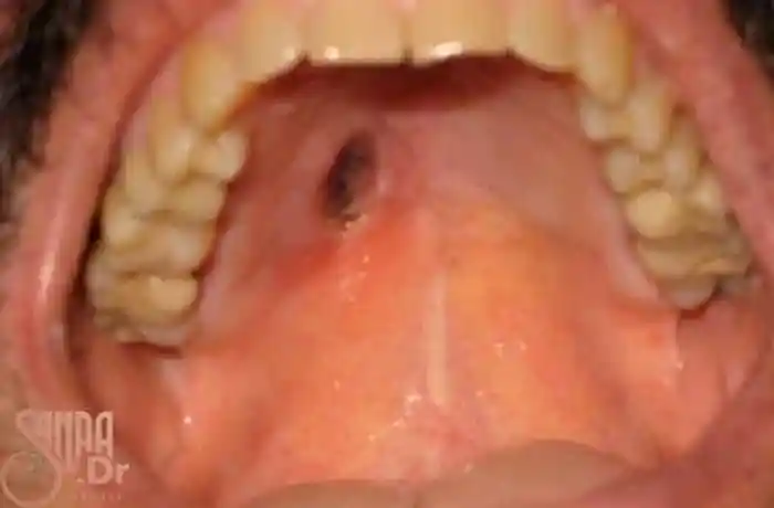 سقف دهان فرد که زخم سیاه شده است.