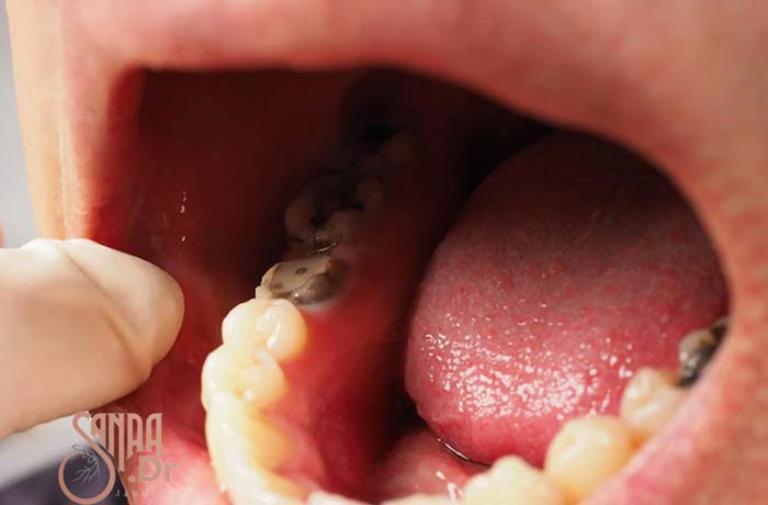 دندان فردی که عفونت کرده