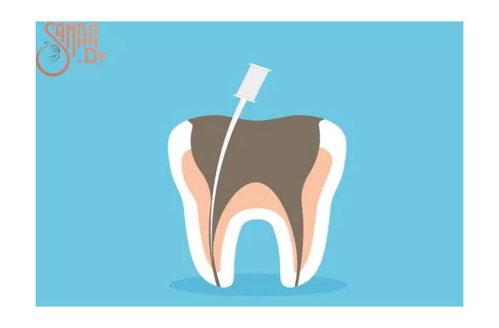 یک دندان را نشان میدهد که دارد عصب کشی روی آن انجام می شود.