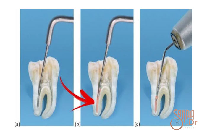 سه مرحله از انجام عصب کشی زوی دندان را نشان میدهد.
