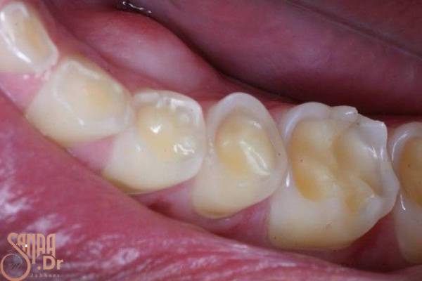 حساسیت دندان به سرما