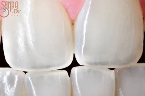 از بین رفتن مینای دندان