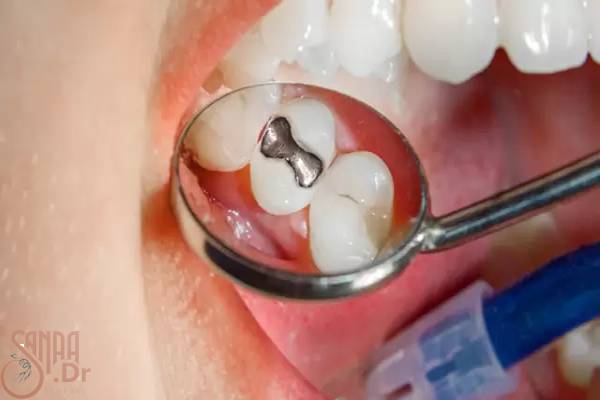  پر کردن دندان بدون عصب کشی