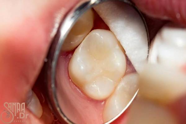 پر کردن دندان بدون عصب کشی