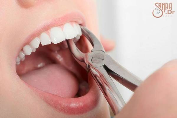 ایا کشیدن چند دندان همزمان ممکن است؟