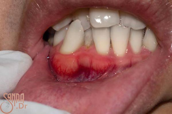 دندان جلوی فردی که ورم دارد و دندان نا منظم دارد.