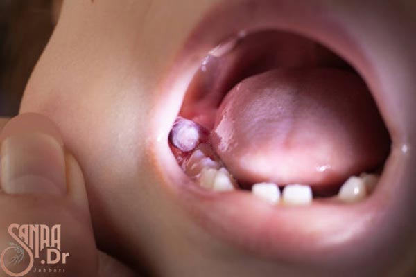 درمان آبسه دندان کودک و دهان کودکی که باز است و لثه اش ورم دارد.