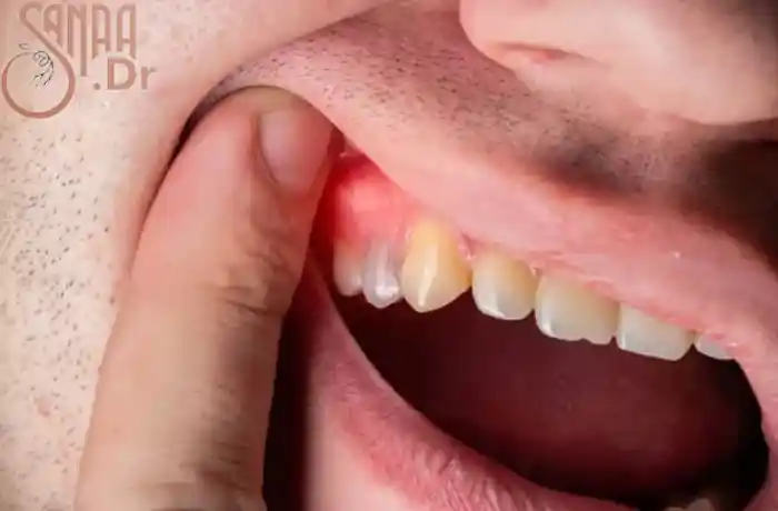 آبسه دندانی یک فرد