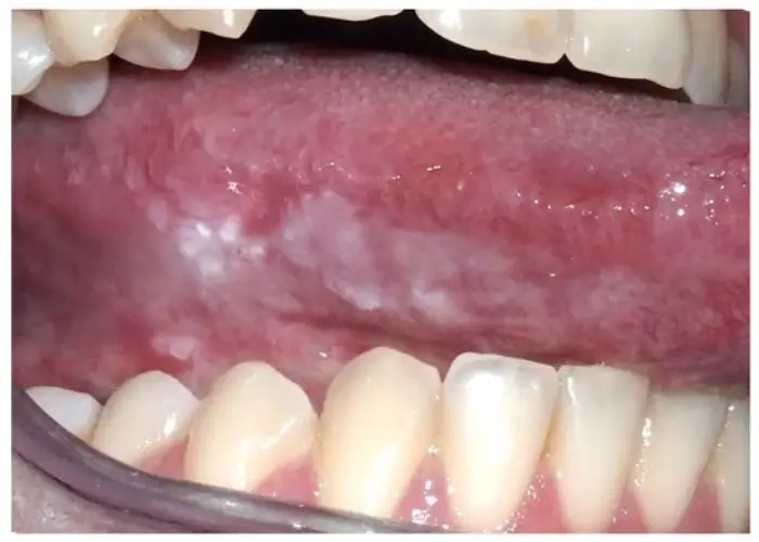 علائم بروز سرطان دهان و دندان