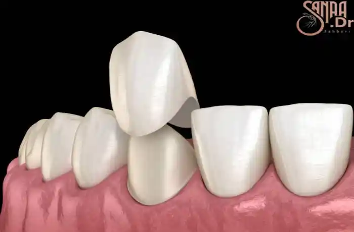 عکس سه بعدی از قرار دادن روکش روی دندان