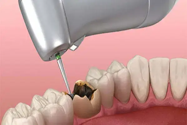 دندان خرابی که دارد تراشیده می شود با وسایل دندان پزشکی
