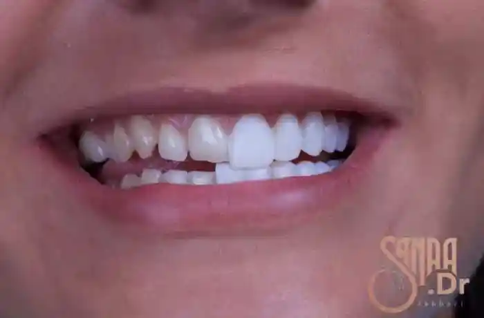 دندان های یک فرد با روکش و بدون روکش