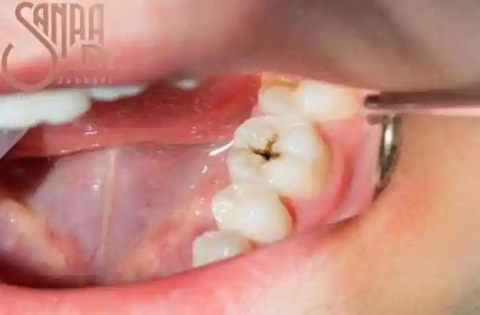 دندان پوسیده یک فرد
