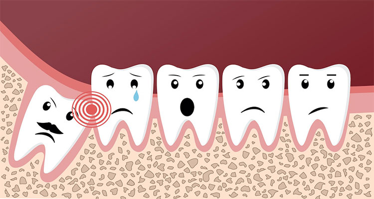 فشار دندان عقل به دندان های دیگر