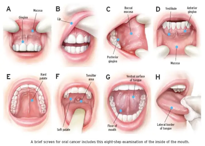 انواع مختلف سرطان دهان و دندان
