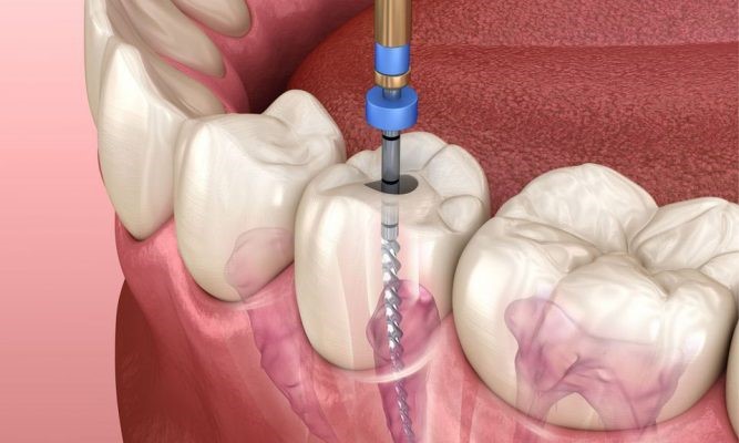 چگونه درد دندان به عصب رسیده را کم کنیم