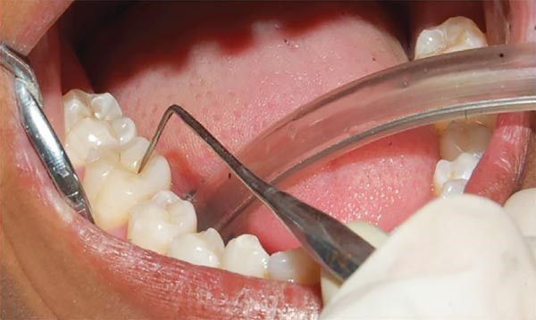 تست وایتالیتی دندان چیست