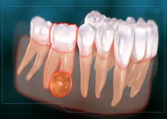 کیست ریشه دندان چگونه ایجاد می شود؟