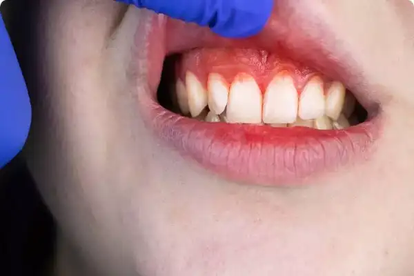 علت خون ریزی دندان عصب کشی شده 