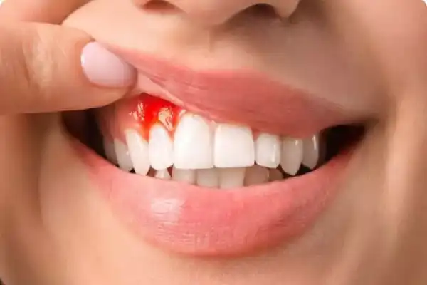 علت خون ریزی دندان عصب کشی شده