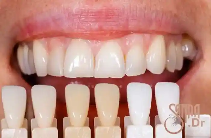 انواع روکش دندان عصب کشی شده با رنگ های مختلف