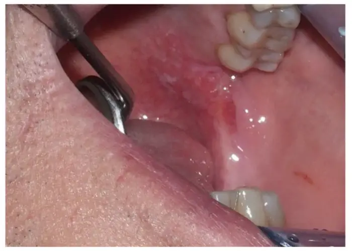 سرطان دهان و دندان چیست؟