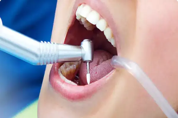 فاصله بین عصب کشی و روکش دندان