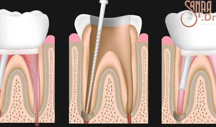 مراحل درمان ریشه دندان. چند دندان که یک سوزن در یک دندان فرورفته است.