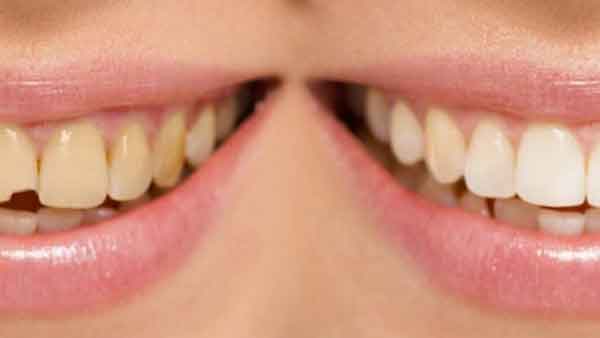 روش های موثر برای ترمیم ریشه دندان شکسته
