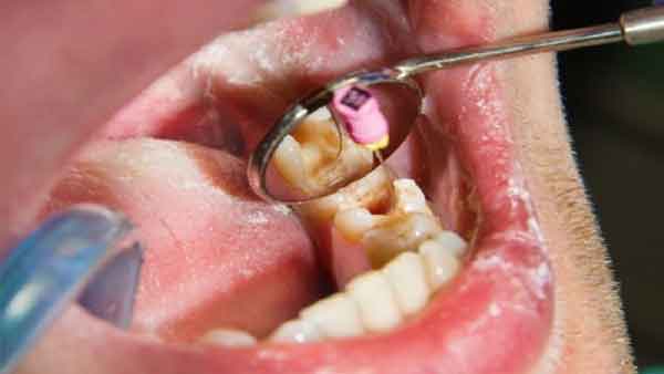 عصب کشی ریشه کج دندان