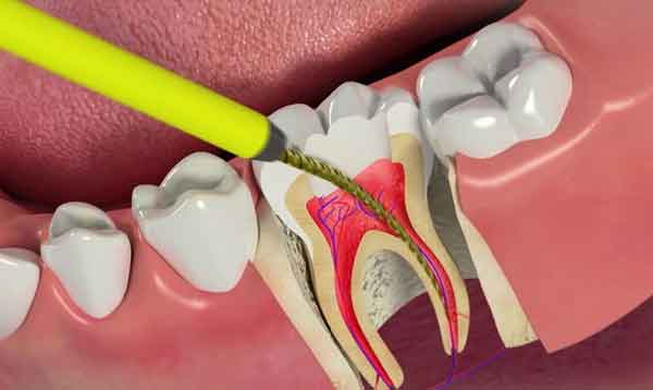 علت کج شدن ریشه دندان