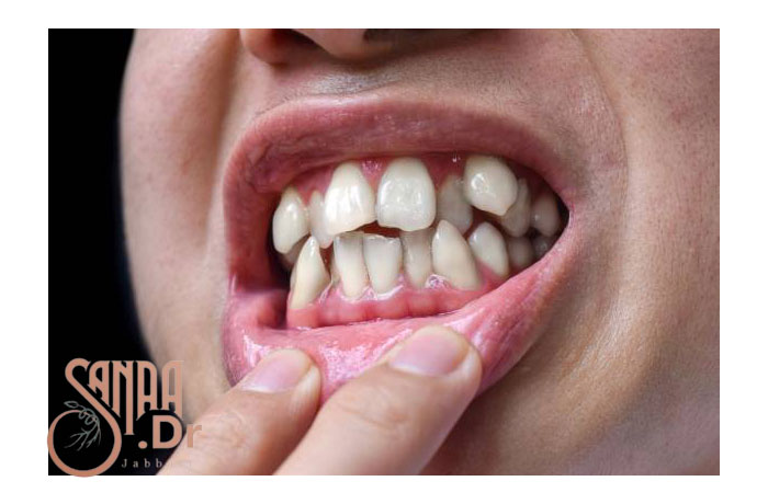 دندان های نا مرتب